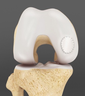  Cartilage Transplant More