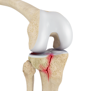  Knee Fracture Surgery 