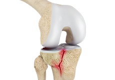 Knee Fracture 