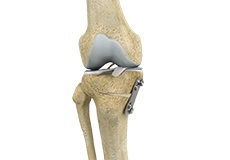 Knee Osteotomy