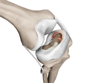 Meniscal Injuries 