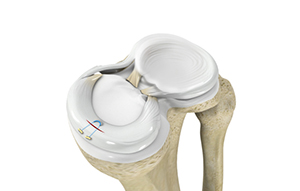  Meniscal Repair Surgery 