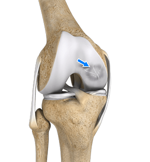 Osteochondral Defect Of The Knee  