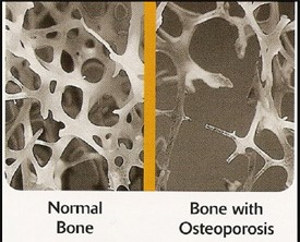 Osteoporosis