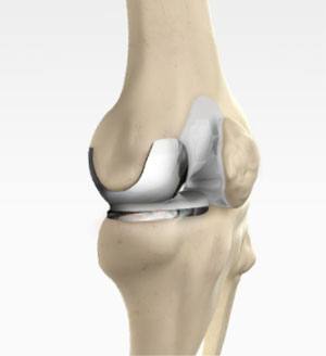  Unicompartmental/Partial Knee Replacement 