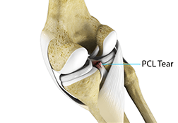 PCL Injuries 