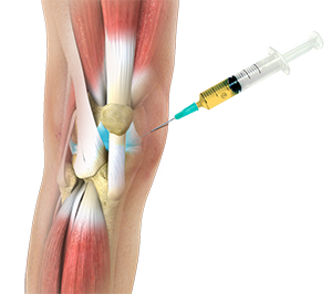  PRP Knee Therapy 